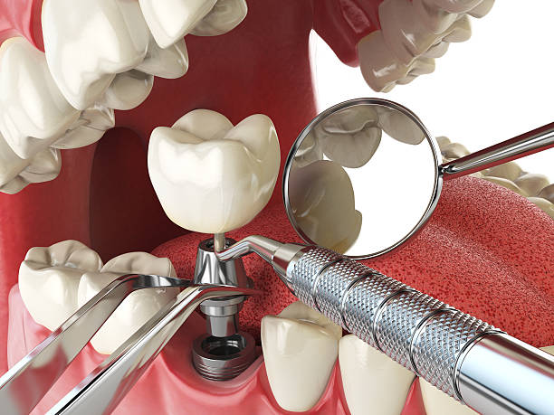 Best Emergency Wisdom Teeth Removal in Kershaw, SC